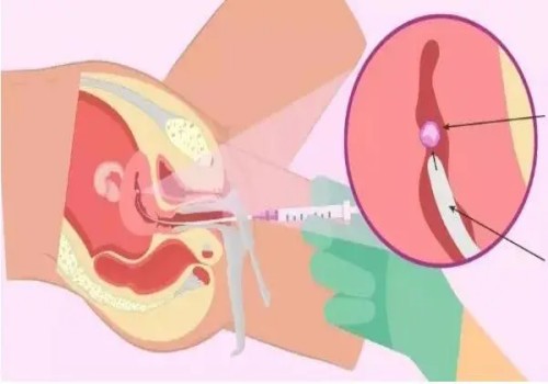 上海代怀生男孩机构：胚胎移植多久能测出怀孕了？胚胎移植后着床的预兆